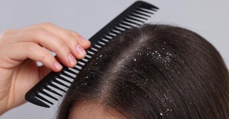 Normal Hair treatment Dedruf