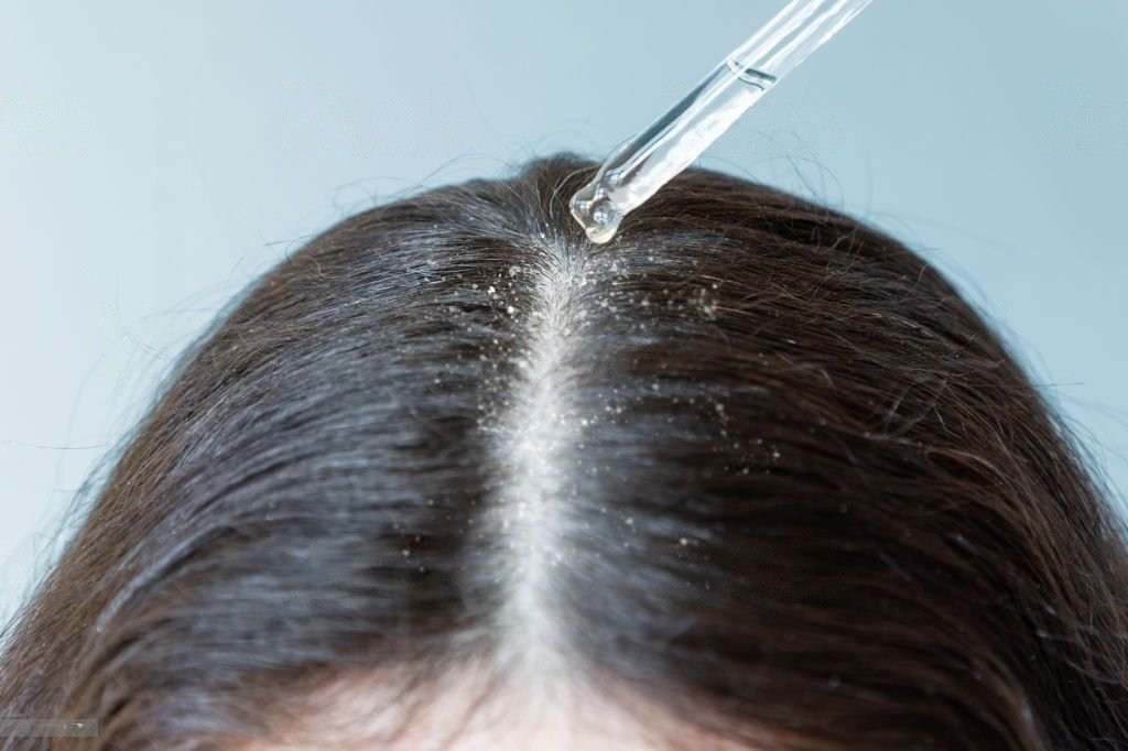 Raga Anti-Dandruff Hair Treatment